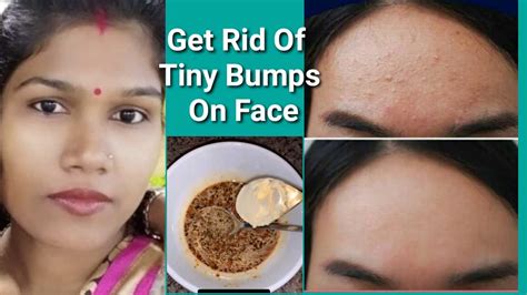 Get Rid Of Tiny Bumps On Face Simple Home Remedies Get Rid Of Tiny Bumps On Face Simple Home