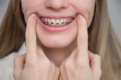 Metal Braces The Price Differences And Benefits Vs Ceramic Braces