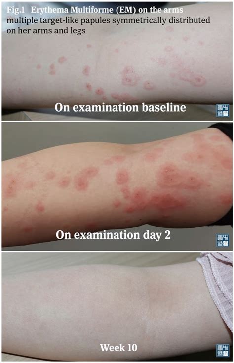 Erythema Multiforme Or Urticaria Vasculitis Different Paths Lead To