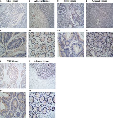 TIGIT CD CD Expression In Colorectal Cancer And Adjacent Tissues