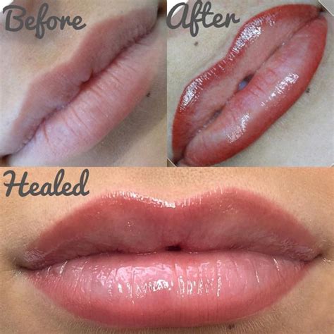 🏆 M I R I A M 🏆 On Instagram “💋👄💉 Stages Of Lip Procedure 🙌🏻 Seamless