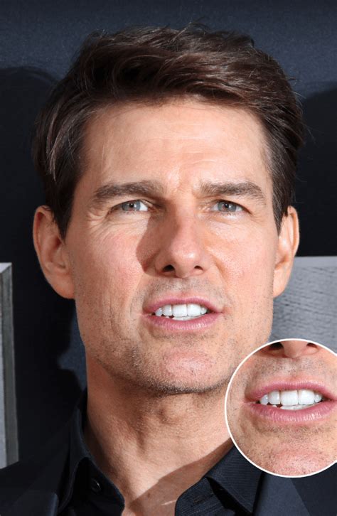 Tom Cruise Klinefelter Syndrome