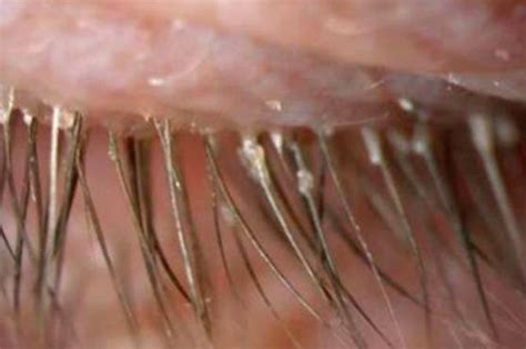 Eye Parasites Over 100 Caused This Womans Eye Itching And Redness