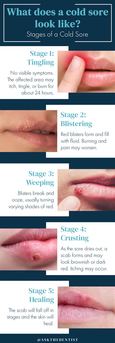 Gradually a scab result on the upper layer of the skin. Cold Sores: Pictures, Symptoms, Causes, and Treatments