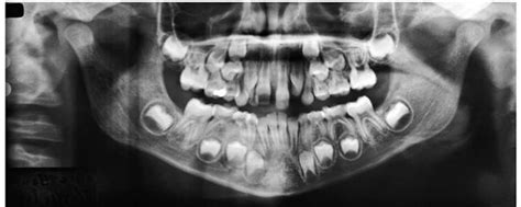Baby Tooth Teeth Xray Child Costaricatravels3