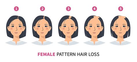 Hair Loss Stages Androgenetic Alopecia Female Pattern Fphl Steps Of