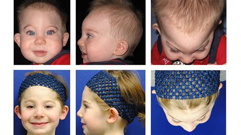 Surgical Treatment For Craniosynostosis Childrens Hospital Of