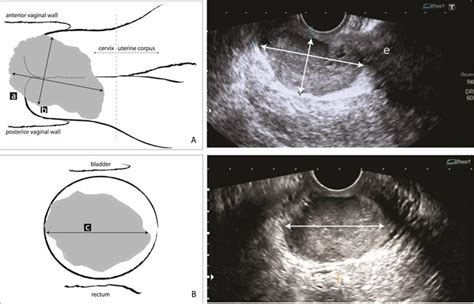 transvaginal ultrasound noninvasive method for the prediction of response to concurrent