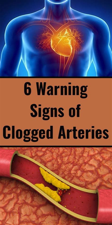6 Warning Signs Of Clogged Arteries While A Lot Of People Suffer From