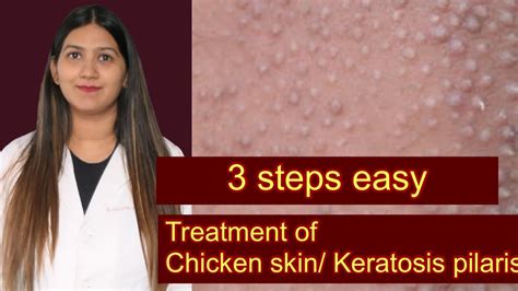 Keratosis Pilaris Treatment Chicken Skin Disease Bumps On Upper