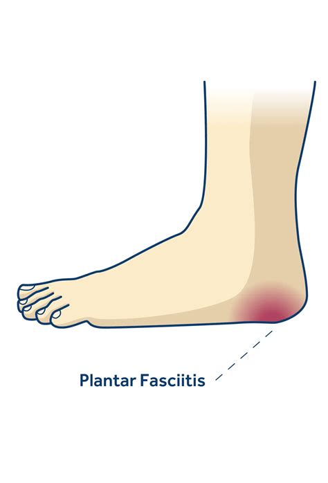Plantar Fasciitis Dapto Foot Clinic