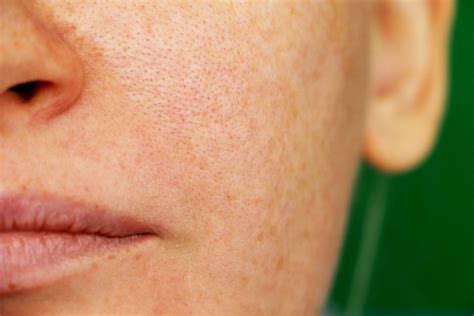 Laser Genesis The Ultimate Way To Minimize Pores Vein Laser Institute