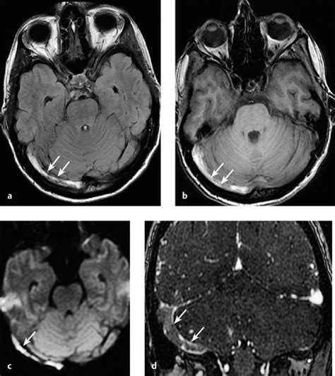 Cerebral Venous And Sinus Thrombosis Radiology Key