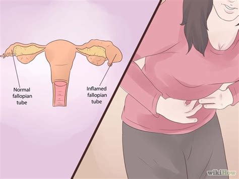 Blocked Fallopian Tube Is The Major Cause Of Infertility Doctor