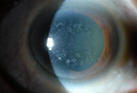 Corneal Dystrophies And Scars Wills Eye Hospital