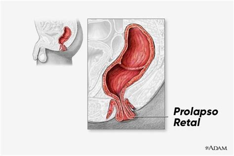 rectal prolapse what it is symptoms causes and treatment