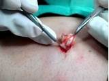 Medical Cyst Extraction Pictures