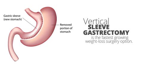 laparoscopic vertical sleeve gastrectomy aloha surgery weight loss surgery