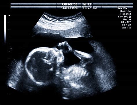 Pregnancy Xray Stock Photos Pictures And Royalty Free Images Istock