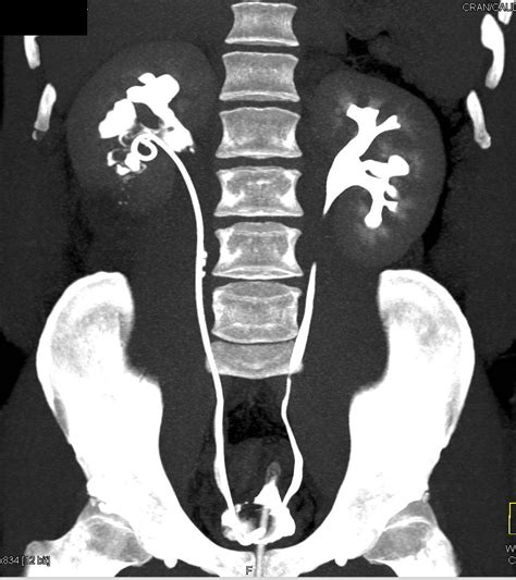 Obstructed Ureter With Pyelosinus Extravasation Of Contrast Kidney