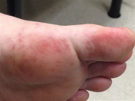 Hand Foot And Mouth Disease Consultant360