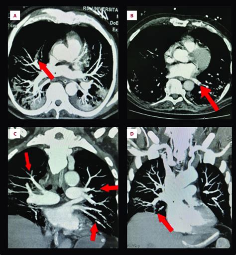 Ct Pulmonary Angiography Showing Multiple Pulmonary Thromboses A