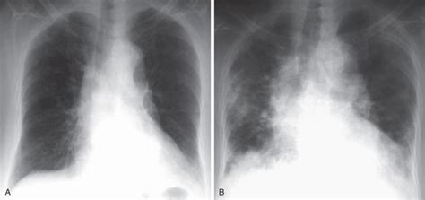 Acute Interstitial Pneumonia Radiology Key