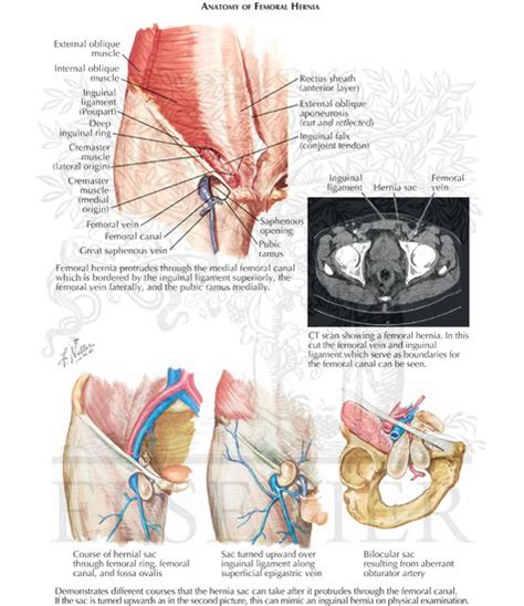 Femoral Hernia Anatomy Anatomy Diagram Book The Best Porn Website