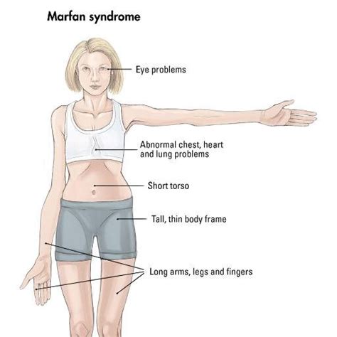 Famous People With Marfan S Syndrome 4 Quadrants Of Leadership Style