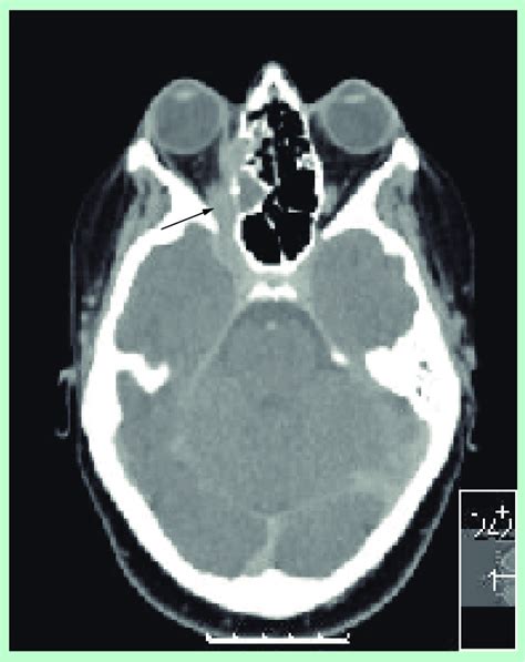 Orbital Wegeners Granulomatosis Granulomatosis With Poly Angiitis