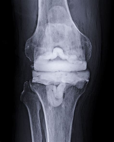 Infected Knee Replacement Adam Sassoon Md Ms