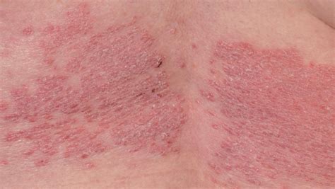 Outcomes Of Psoriasis Treatment Can Be Predicted By White Blood Cell