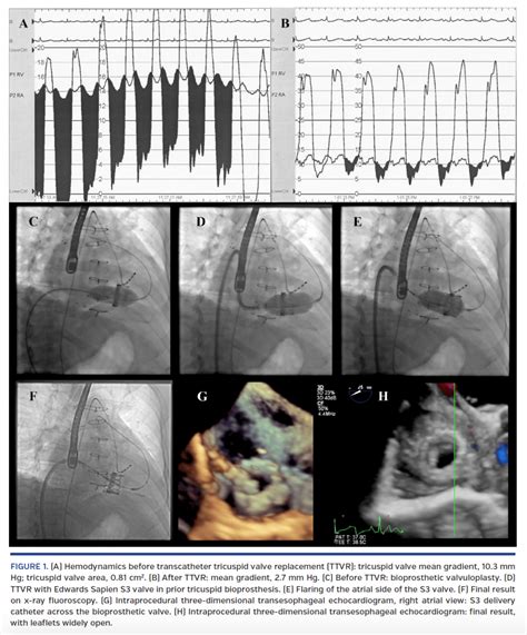 Transcatheter Tricuspid Valve Replacement In Orthotopic Heart Transplant