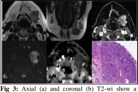 Figure 3 From Mri Features In Submandibular Gland Chronic Sclerosing