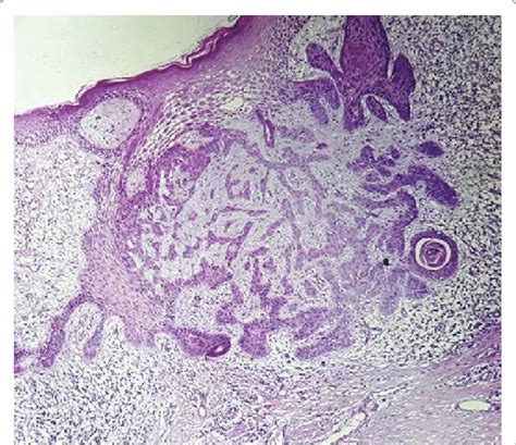 Histological Section Of Basal Cell Carcinoma Case 1 Download