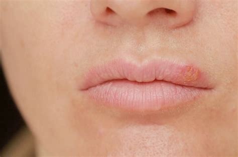 Lip Dermatitis 7 Natural Home Remedies For Lips Eczema Lip