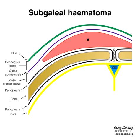 Scalp Hematoma Types Diagram Image
