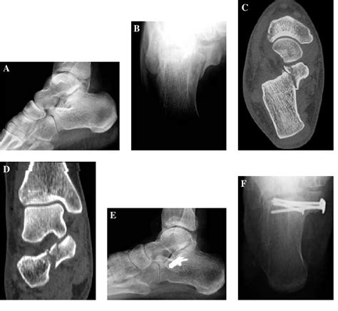 Figure 2 From Fractures Of The Sustentaculum Tali Injury