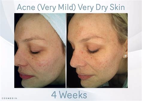 Acne Very Mild Very Dry Skin Cosmedixuk