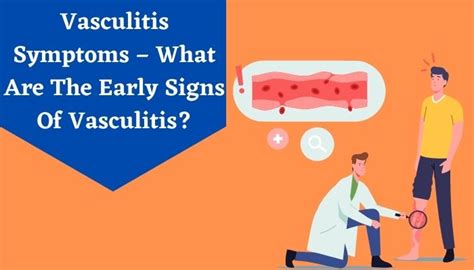 Vasculitis Symptoms Symptoms Diagnosis And Treatments