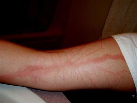 Incredible Photos Reveal What Happens To Your Skin If You Re Struck By Lightning Mirror Online