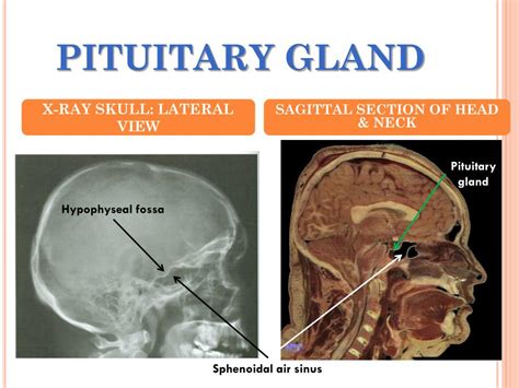 Sphenoid Bone Pituitary Gland