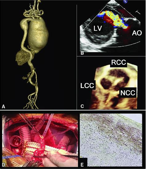 a preoperative computed tomographic 3d reconstruction showing dilation download scientific