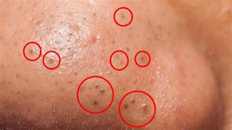 How To Remove Blackheads And Whiteheads On Face Easy 28 Dr Laelia