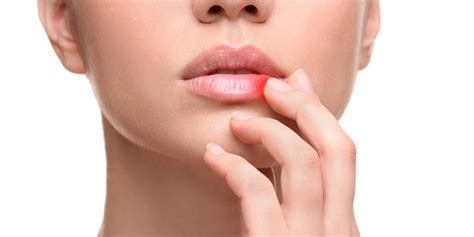 How Can You Get Rid Of Cold Sores Madison Dental Health Associates