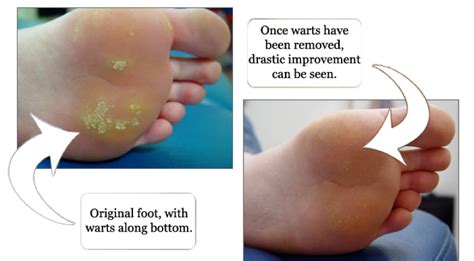 The price of wart removal varies according to the treatment option. Plantar Warts | Global Podiatry