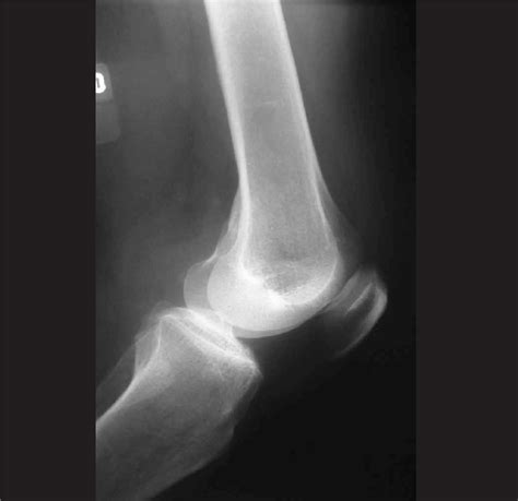 Normal Lateral Knee Radiograph