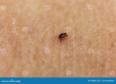 Tick Bitten In Human Skin 7 Stock Image Image Of Dangerous Flea