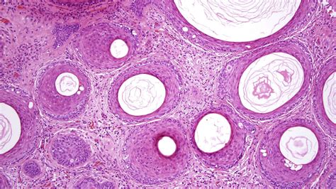 An Overview Of Hair Follicle Tumours Diagnostic Histopathology