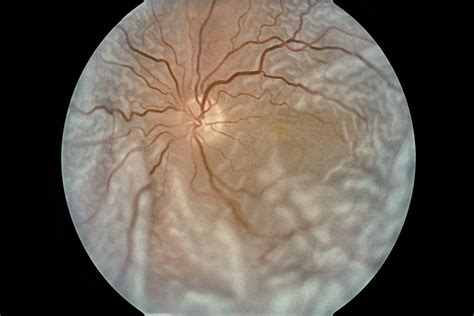 Widefield Oct Shows Effects Of Rhegmatogenous Retinal Detachment